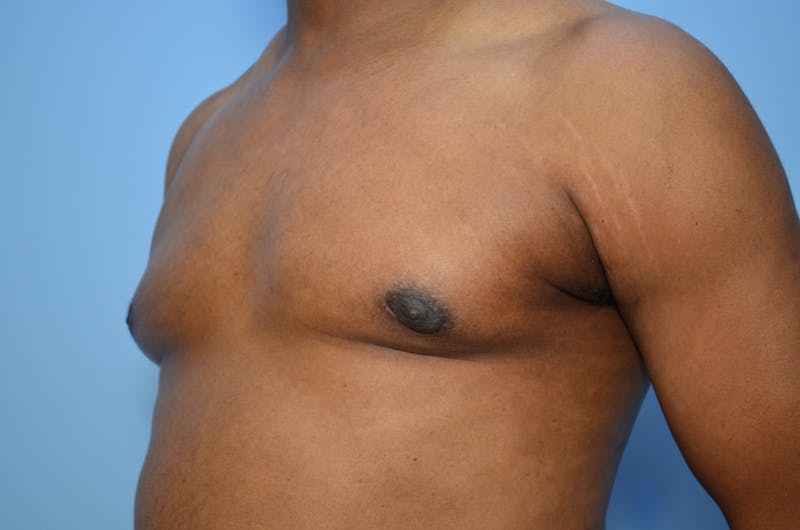 Male Procedures by Dr. Hess Before & After Gallery - Patient 329970 - Image 8