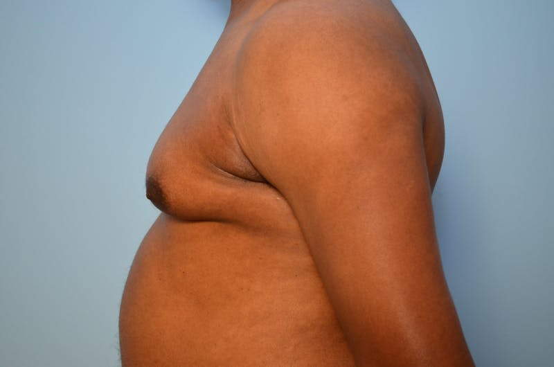 Male Procedures by Dr. Hess Before & After Gallery - Patient 329970 - Image 9