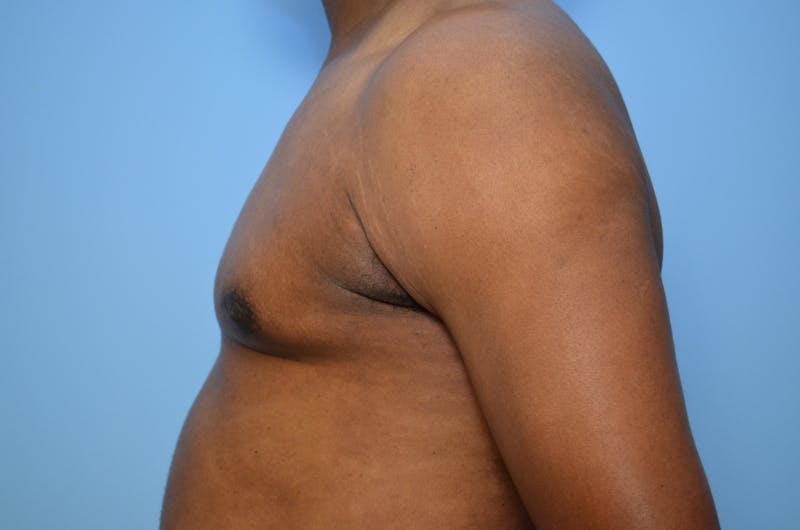 Male Procedures by Dr. Hess Before & After Gallery - Patient 329970 - Image 10