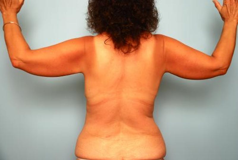 Liposuction Before & After Gallery - Patient 156595 - Image 1