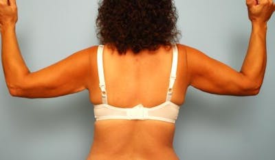 Liposuction Before & After Gallery - Patient 350699 - Image 2