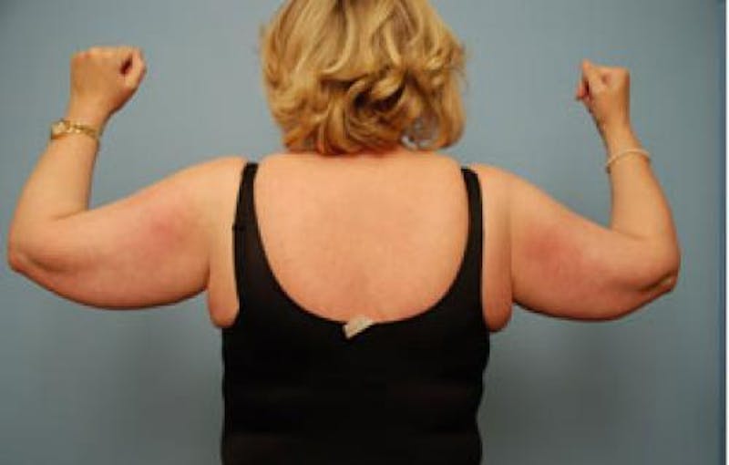 Liposuction Before & After Gallery - Patient 386686 - Image 1