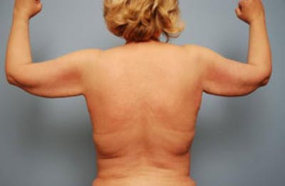 Liposuction Before & After Gallery - Patient 310810 - Image 2