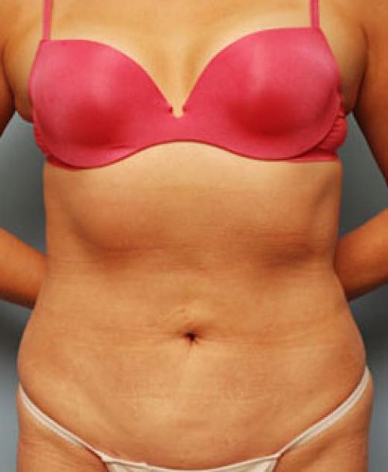 Liposuction Before & After Gallery - Patient 101755 - Image 2