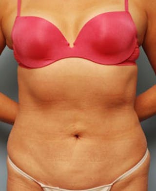 Liposuction Before & After Gallery - Patient 101755 - Image 2