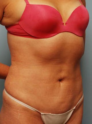 Liposuction Before & After Gallery - Patient 101755 - Image 4