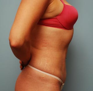 Liposuction Before & After Gallery - Patient 101755 - Image 6