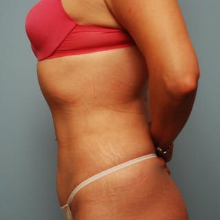 Liposuction Before & After Gallery - Patient 101755 - Image 8