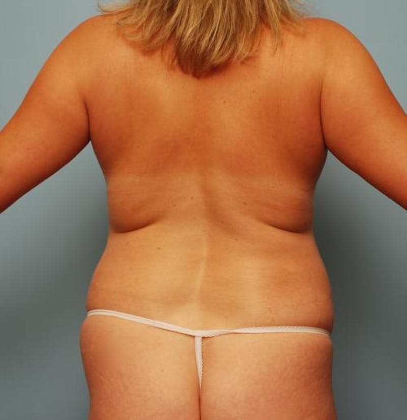 Liposuction Before & After Gallery - Patient 101755 - Image 9