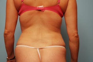 Liposuction Before & After Gallery - Patient 101755 - Image 10