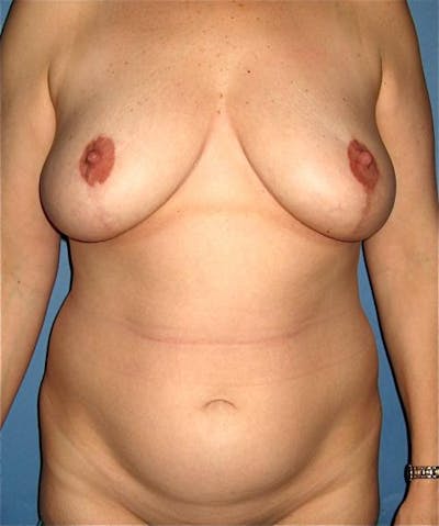 Liposuction Before & After Gallery - Patient 132074 - Image 1