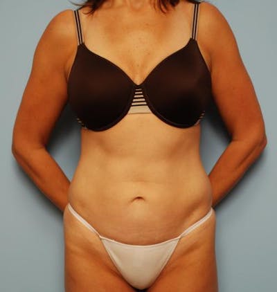 Liposuction Before & After Gallery - Patient 132074 - Image 2
