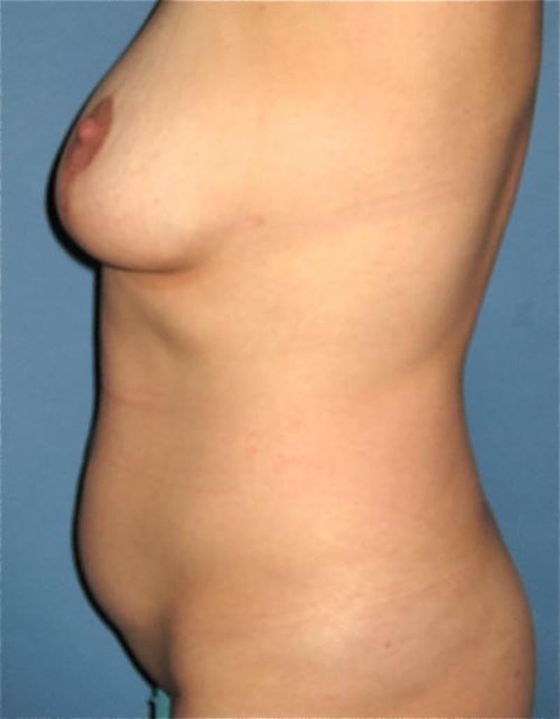 Liposuction Before & After Gallery - Patient 443739 - Image 3