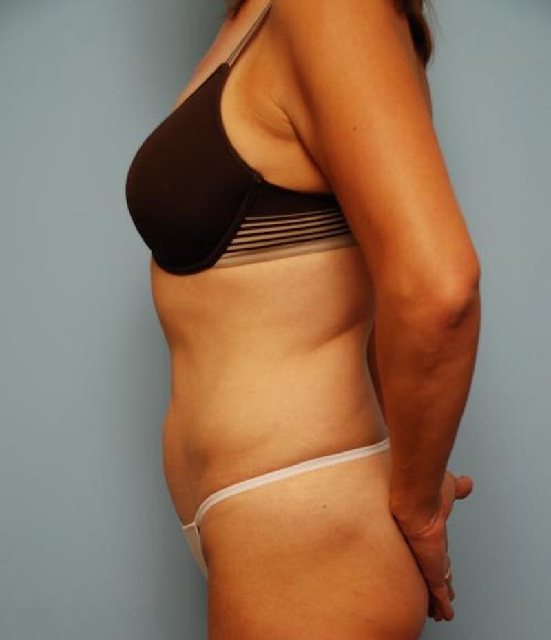 Liposuction Before & After Gallery - Patient 443739 - Image 4