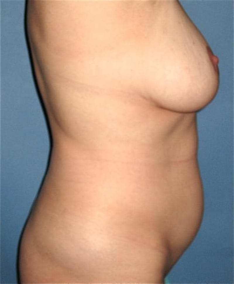 Liposuction Before & After Gallery - Patient 443739 - Image 5