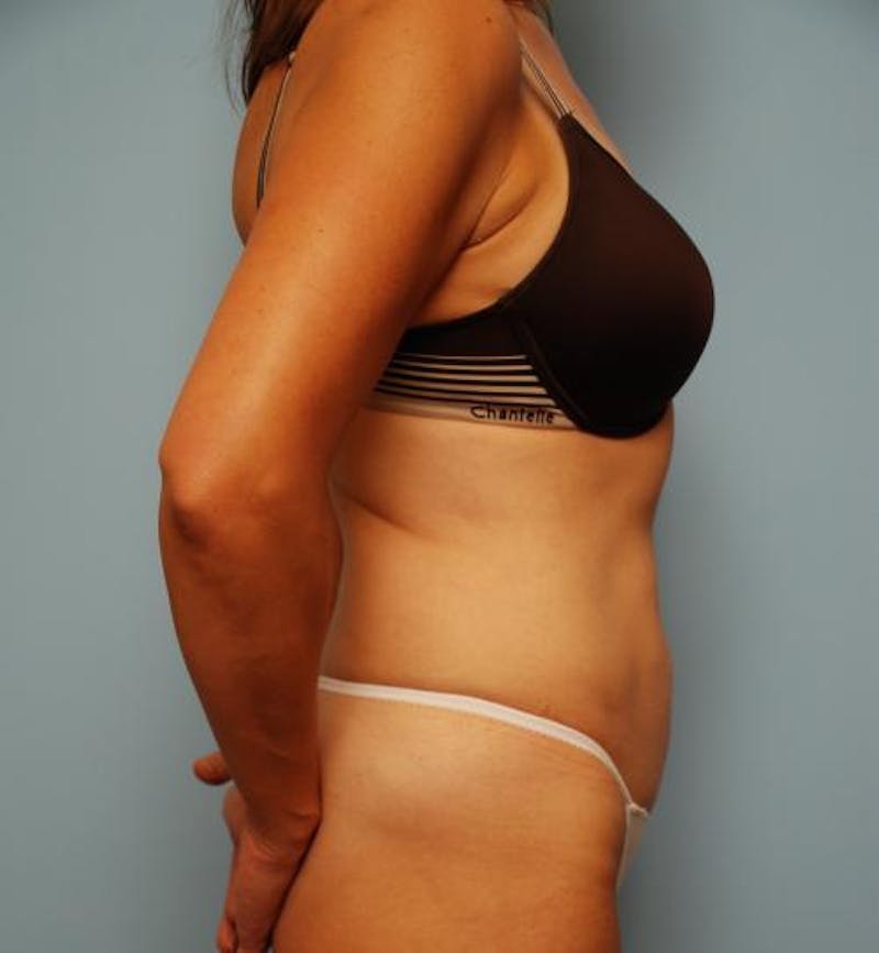 Liposuction Before & After Gallery - Patient 443739 - Image 6