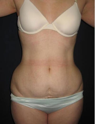 Liposuction Before & After Gallery - Patient 380529 - Image 1