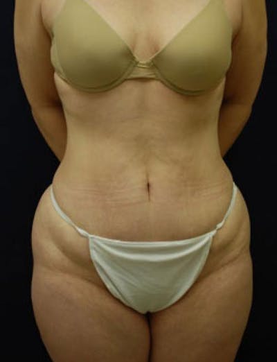 Liposuction Before & After Gallery - Patient 380529 - Image 2