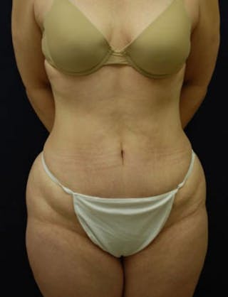 Liposuction Before & After Gallery - Patient 269320 - Image 2