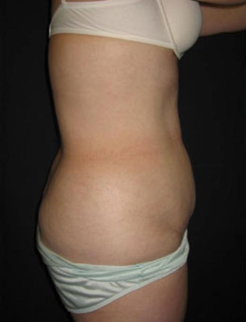 Liposuction Before & After Gallery - Patient 269320 - Image 3