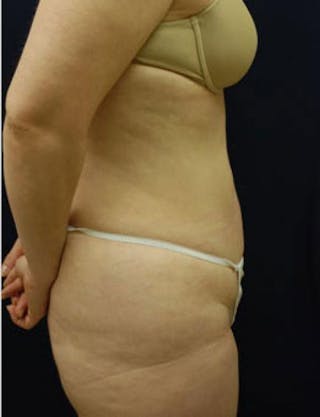 Liposuction Before & After Gallery - Patient 269320 - Image 4
