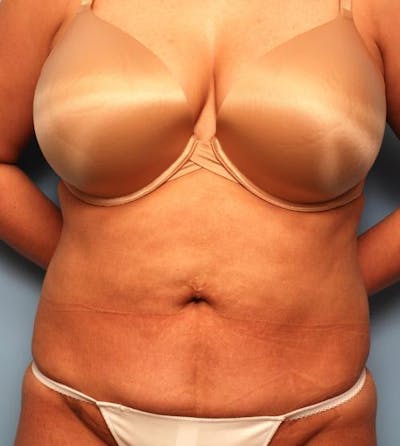 Liposuction Before & After Gallery - Patient 307045 - Image 2