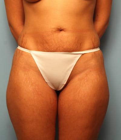 Liposuction Before & After Gallery - Patient 280388 - Image 1