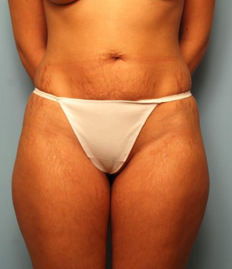 Liposuction Before & After Gallery - Patient 355204 - Image 1