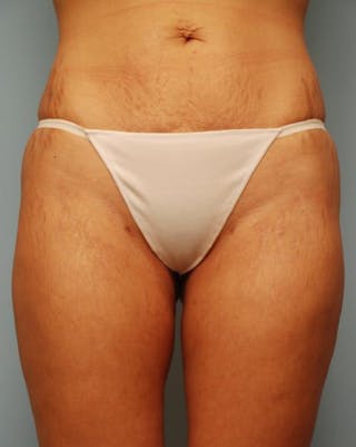 Liposuction Before & After Gallery - Patient 355204 - Image 2
