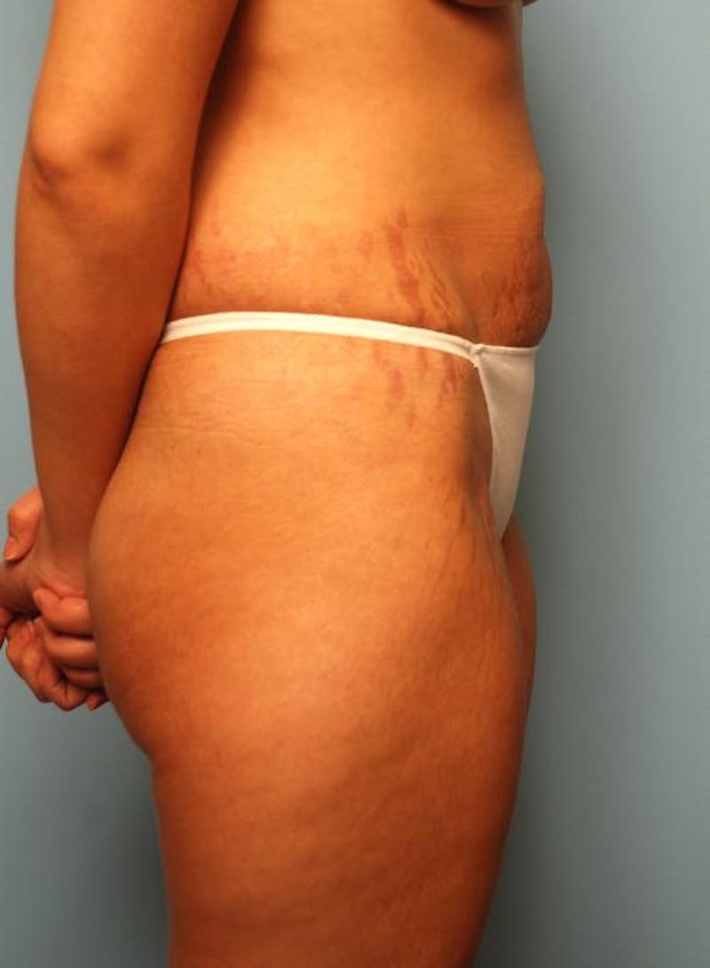 Liposuction Before & After Gallery - Patient 355204 - Image 3