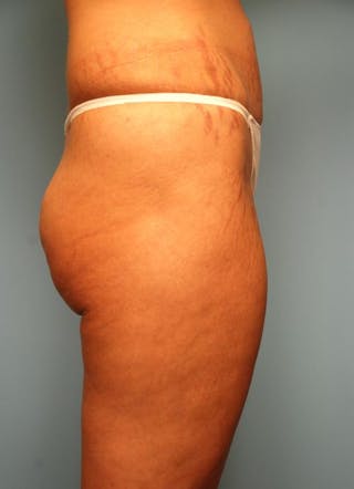 Liposuction Before & After Gallery - Patient 355204 - Image 4