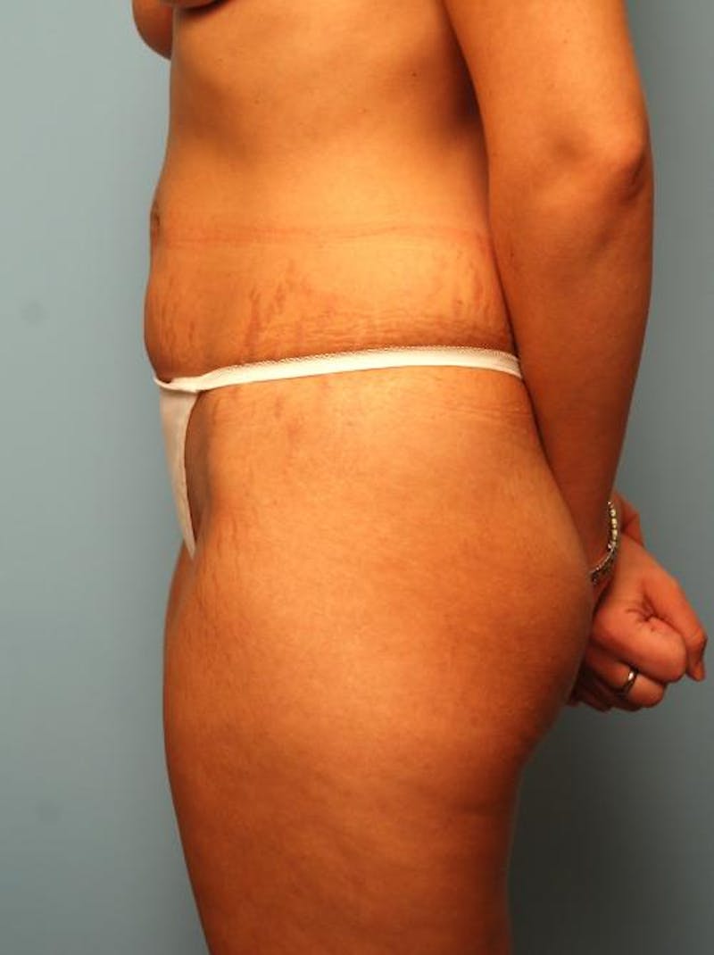 Liposuction Before & After Gallery - Patient 355204 - Image 5