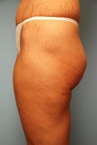 Liposuction Before & After Gallery - Patient 355204 - Image 6