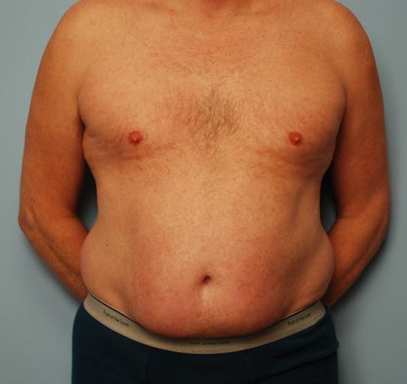 Liposuction Before & After Gallery - Patient 211828 - Image 1
