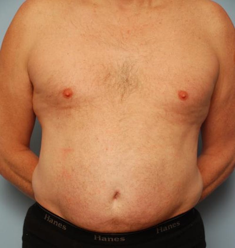 Liposuction Before & After Gallery - Patient 211828 - Image 2