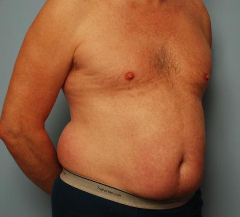 Liposuction Before & After Gallery - Patient 211828 - Image 3