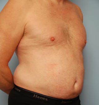 Liposuction Before & After Gallery - Patient 211828 - Image 4