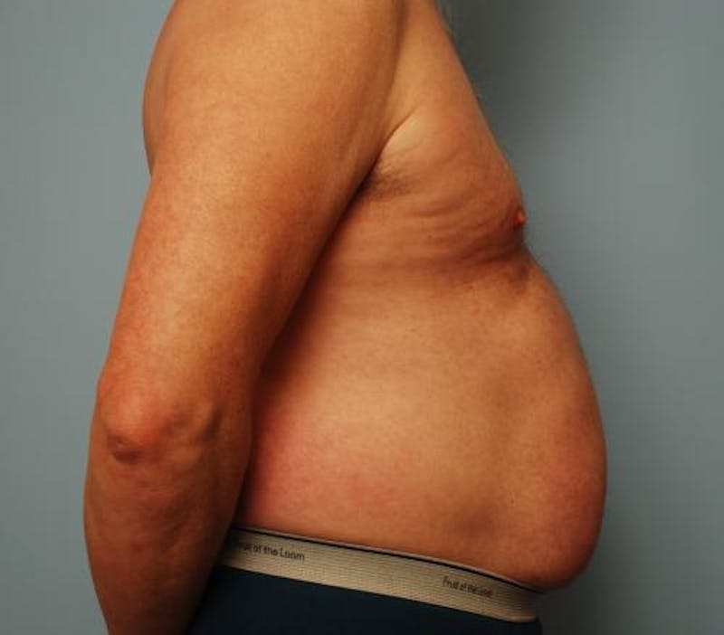 Liposuction Before & After Gallery - Patient 211828 - Image 5