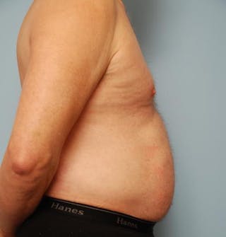 Liposuction Before & After Gallery - Patient 211828 - Image 6