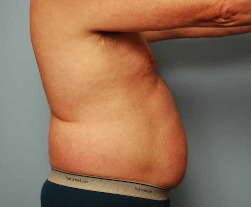 Liposuction Before & After Gallery - Patient 211828 - Image 7