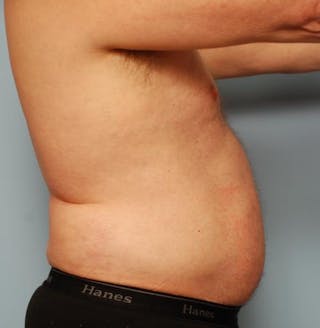 Liposuction Before & After Gallery - Patient 211828 - Image 8