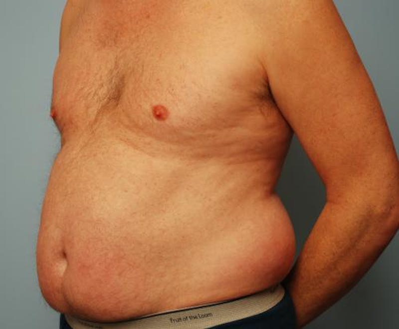 Liposuction Before & After Gallery - Patient 211828 - Image 9