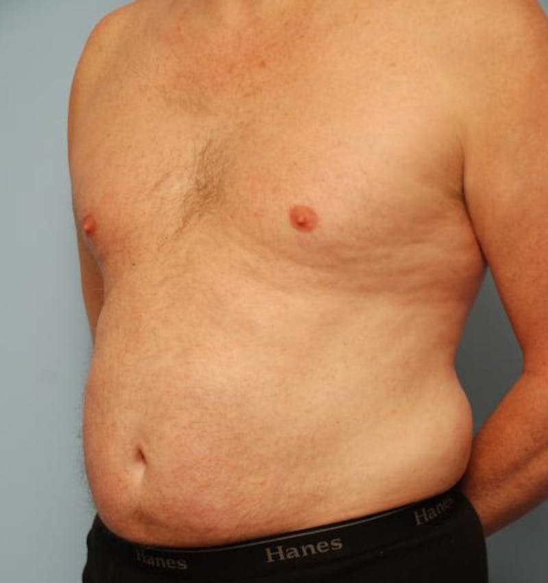 Liposuction Before & After Gallery - Patient 211828 - Image 10