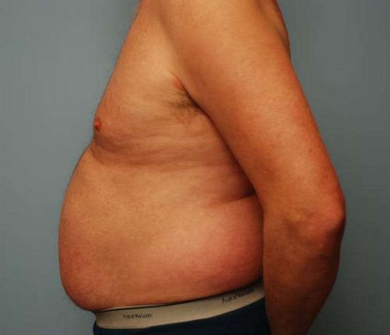 Liposuction Before & After Gallery - Patient 211828 - Image 11