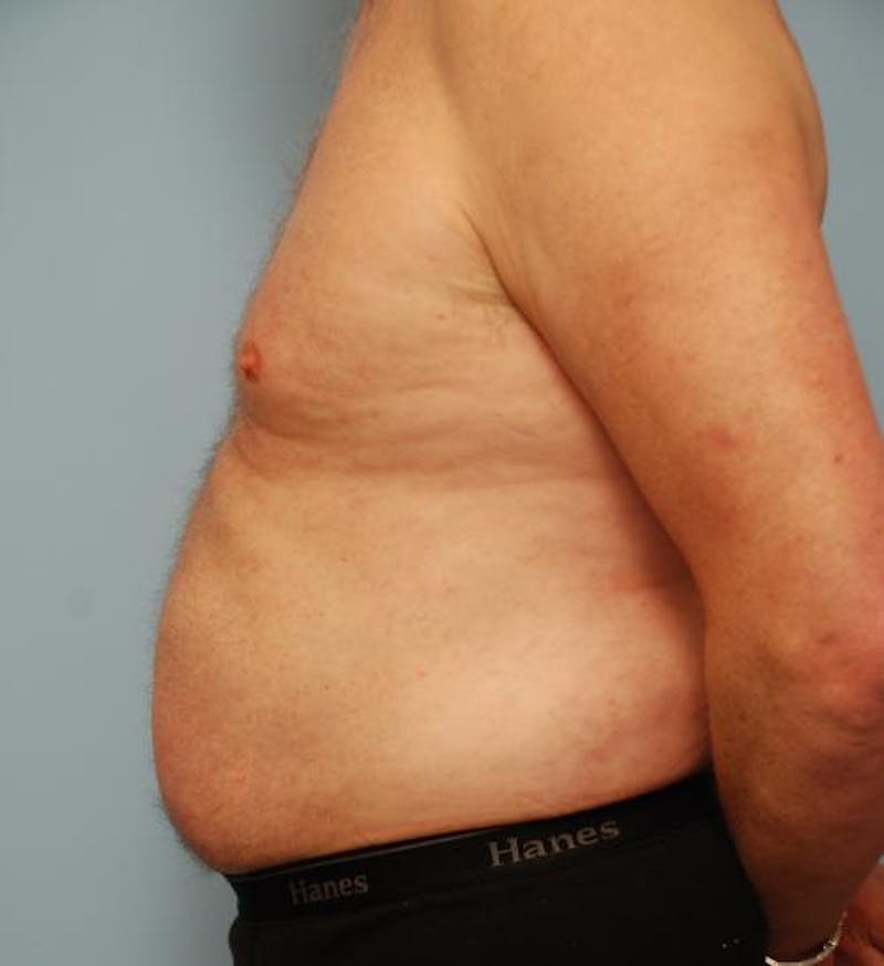 Liposuction Before & After Gallery - Patient 211828 - Image 12