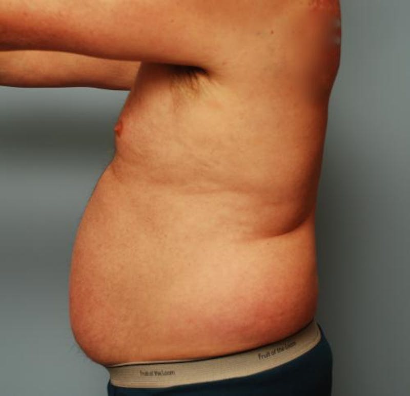 Liposuction Before & After Gallery - Patient 211828 - Image 13