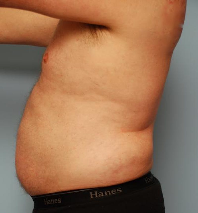 Liposuction Before & After Gallery - Patient 211828 - Image 14