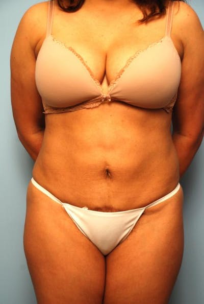 Liposuction Before & After Gallery - Patient 279963 - Image 2