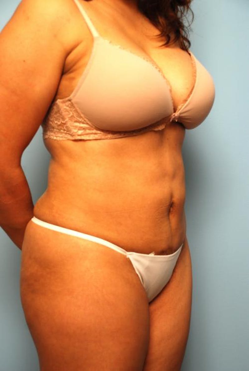 Liposuction Before & After Gallery - Patient 287385 - Image 4