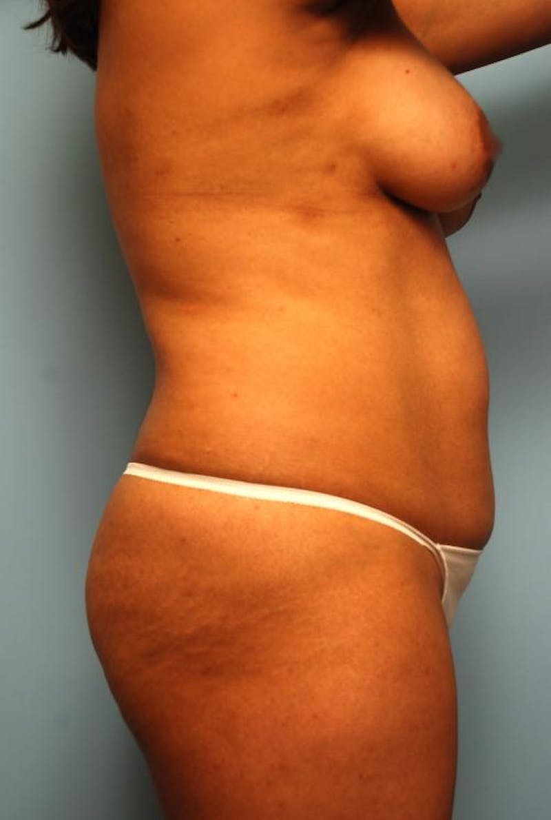 Liposuction Before & After Gallery - Patient 287385 - Image 5